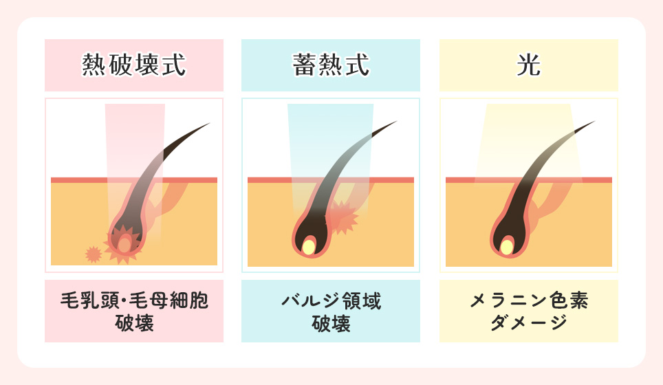 医療脱毛とエステ脱毛のそれぞれの脱毛の特徴一覧