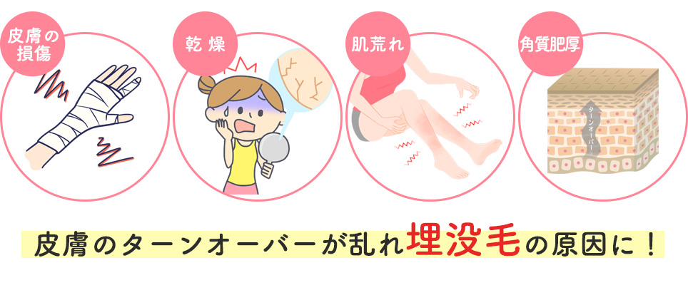 埋没毛の原因まとめ