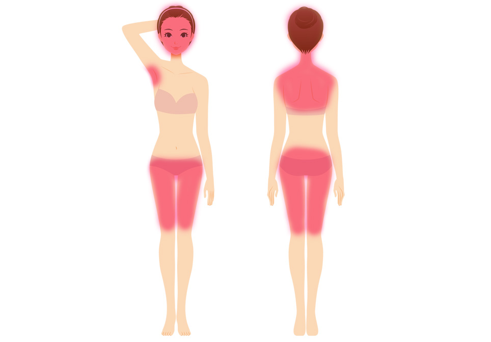 毛嚢炎ができやすい部位の女性版の図説