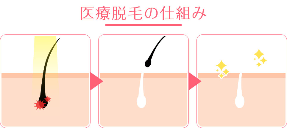 医療脱毛の仕組みの画像