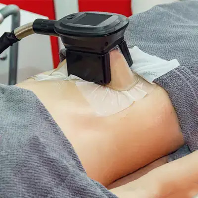 脂肪冷却の画像