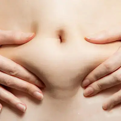 脂肪吸引の画像