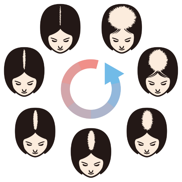 女性の薄毛